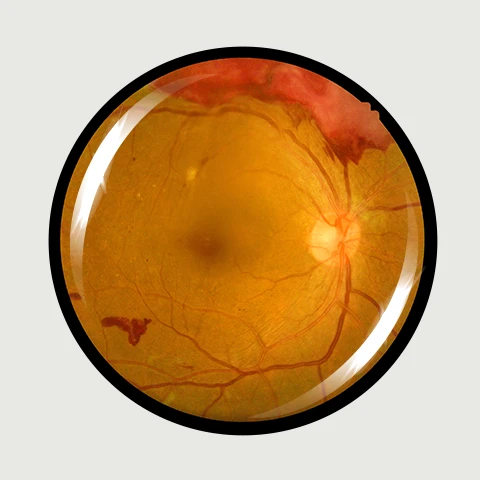 Diabetic Eye Disease