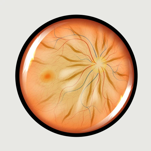 Epiretinal Membrane (ERM)