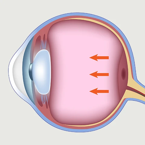 Macular Hole