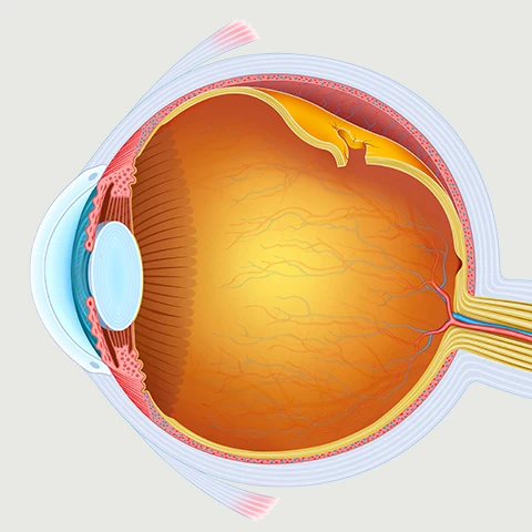 Retinal Detachment