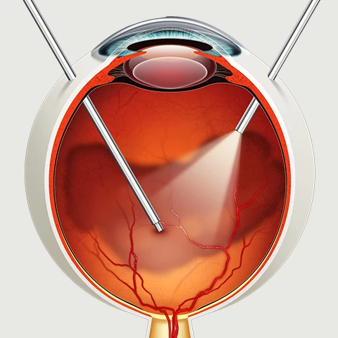 Vitrectomy