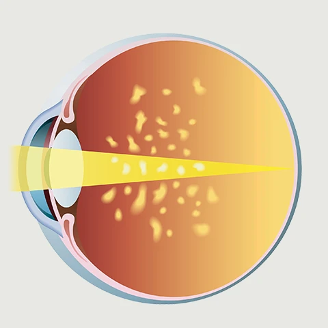 Vitreous Floaters